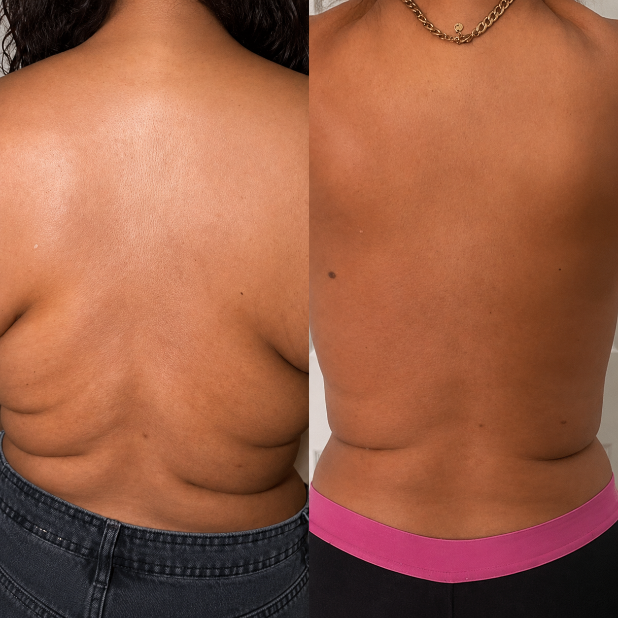 Client back before and after Lemon Bottle treatment