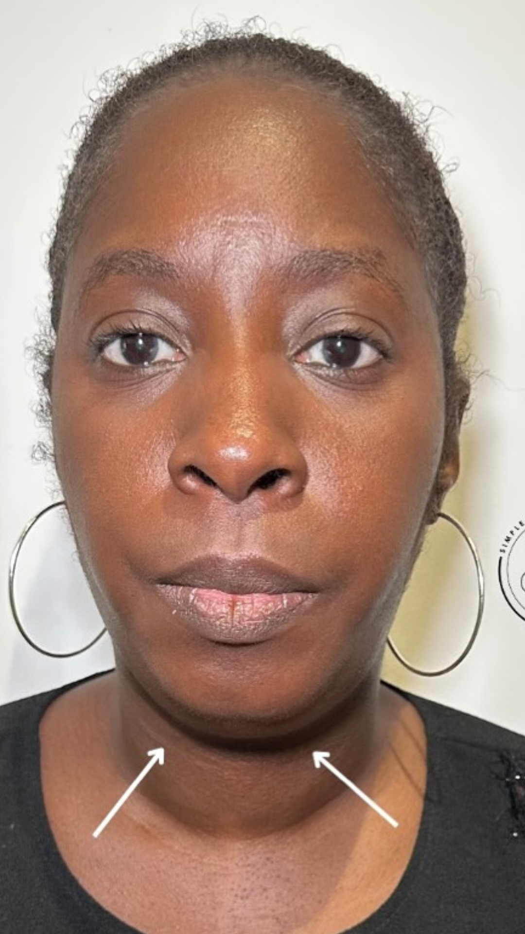 Chin & jawline before Lemon Bottle treatment