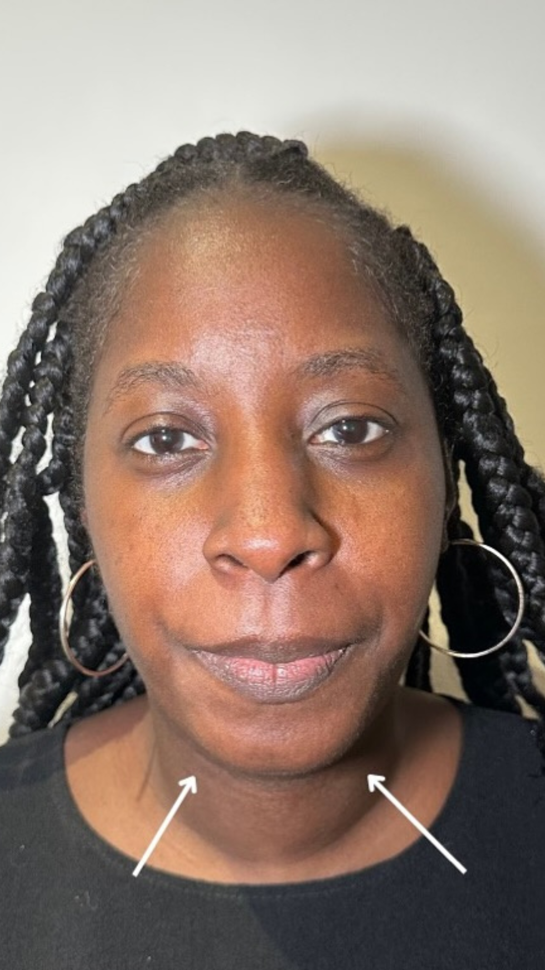 Chin & jawline after Lemon Bottle treatment