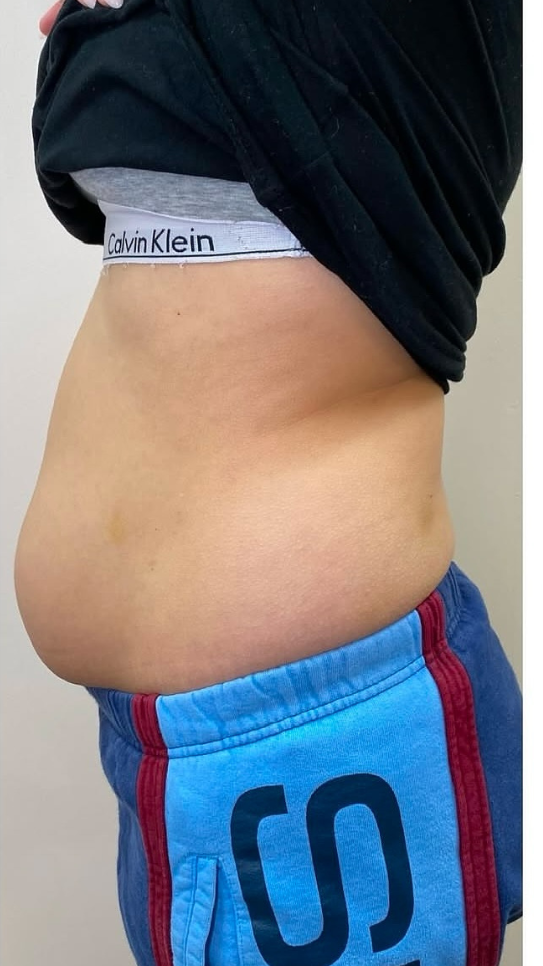 Stomach & waist before Lemon Bottle treatment