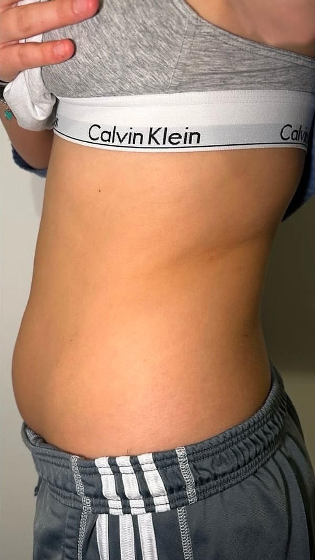 Stomach & waist after Lemon Bottle treatment