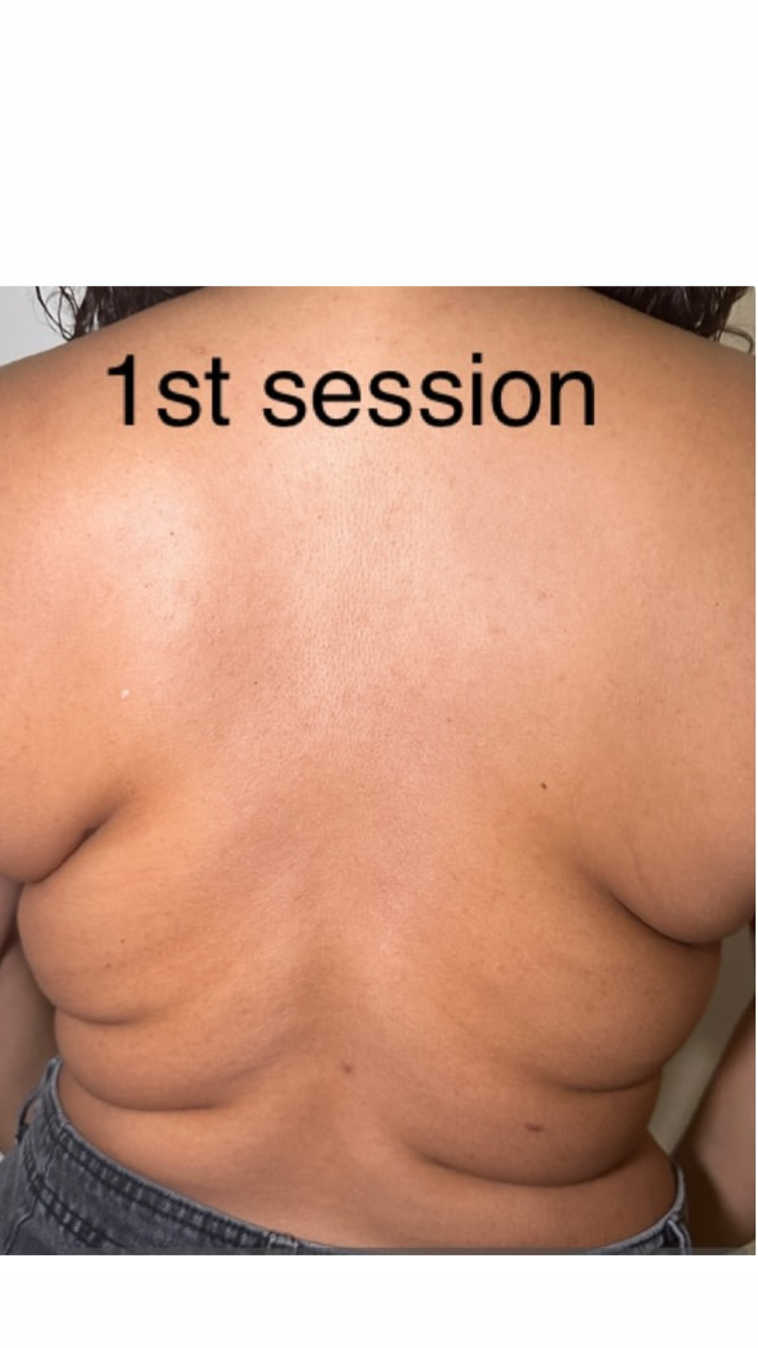 Back & bra fat before Lemon Bottle treatment