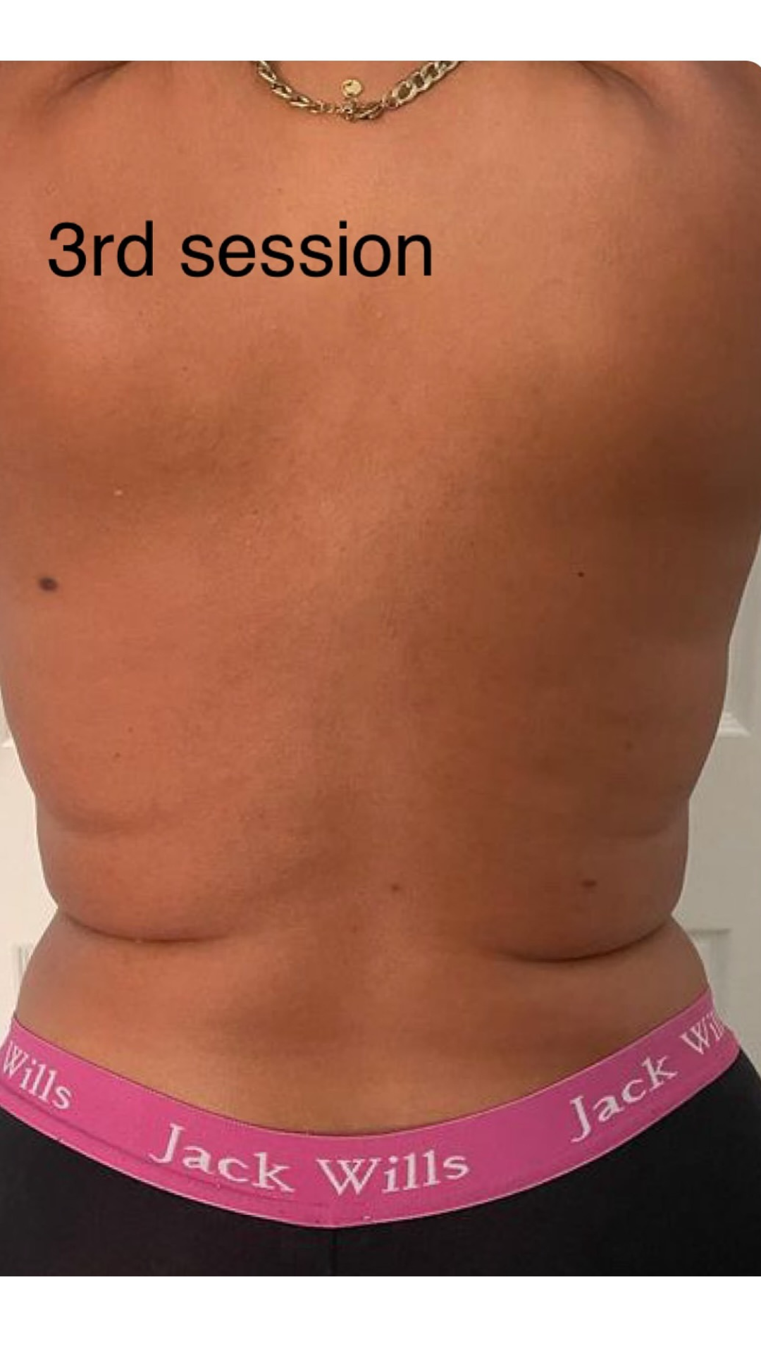 Back & bra fat after Lemon Bottle treatment